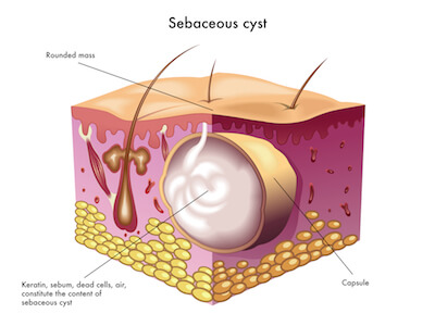 cyst sebaceous removal surgery