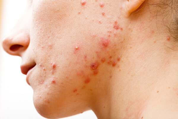 best acne vulgaris treatment singapore