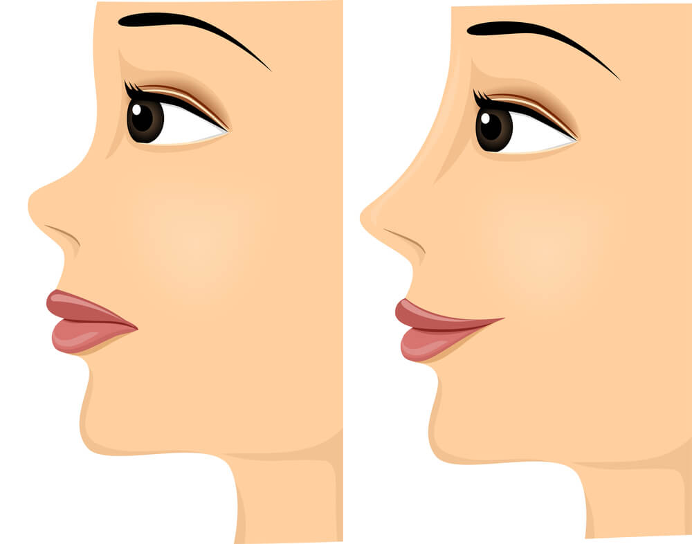 nose threadlift before and after