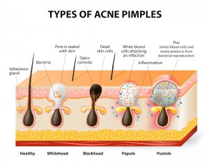 Non Inflamed What causes Blackheads & Whiteheads | Acne Treatment | APAX Medical ...
