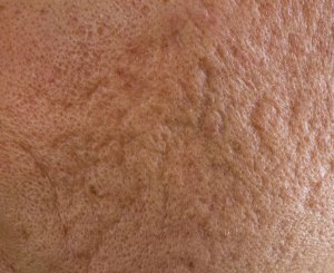 what-caueses-acne-scars