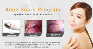 acne scar removal program singapore