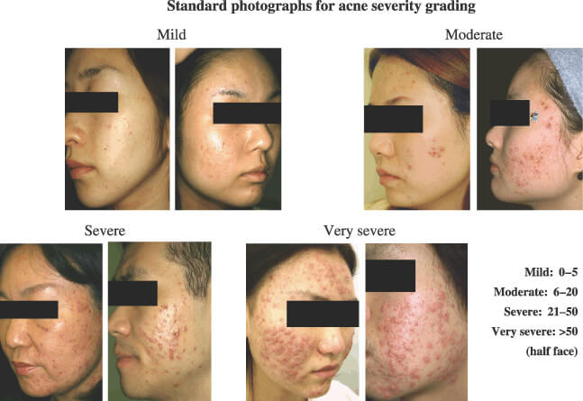 photographs to show acne severity