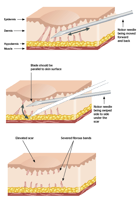 subcision using nook needle illustration
