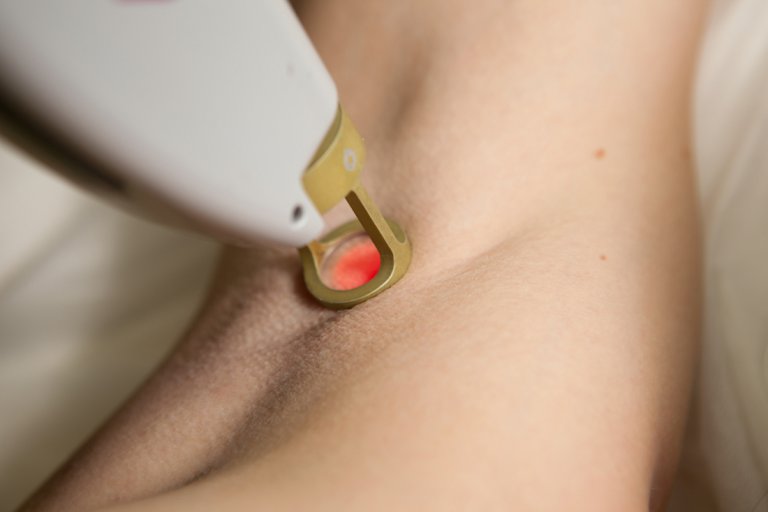 underarm laser treatment procedure Singapore