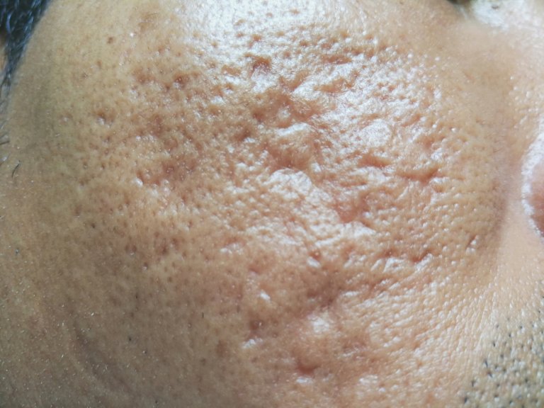 tca cross acne scars in Singapore