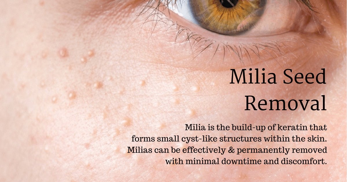 milia seed removal clinic in singapore