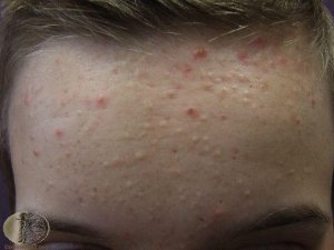 preteen acne has T zone distribution