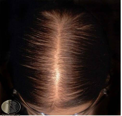 female hair loss treatment in Singapore