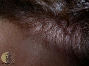 best female hair loss treatment in Singapore