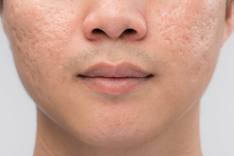 rejuran s acne scars singapore