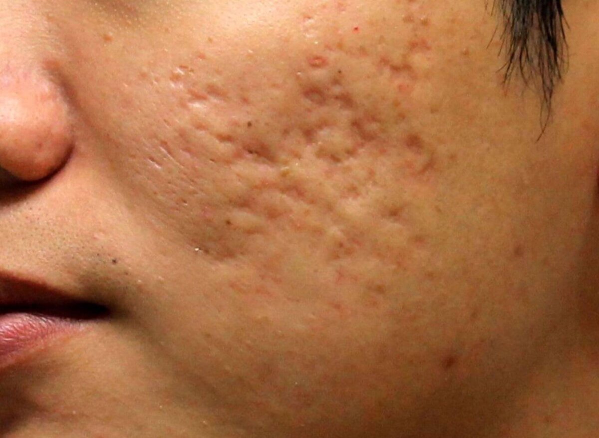 acne scars cheeks
