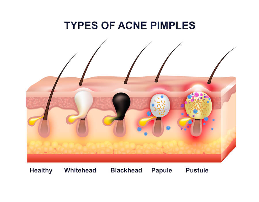 Colored skin acne anatomy composition with types of acne pimples before and after vector illustration