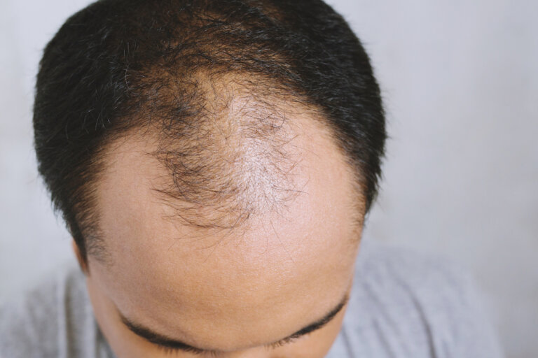 male pattern hair loss