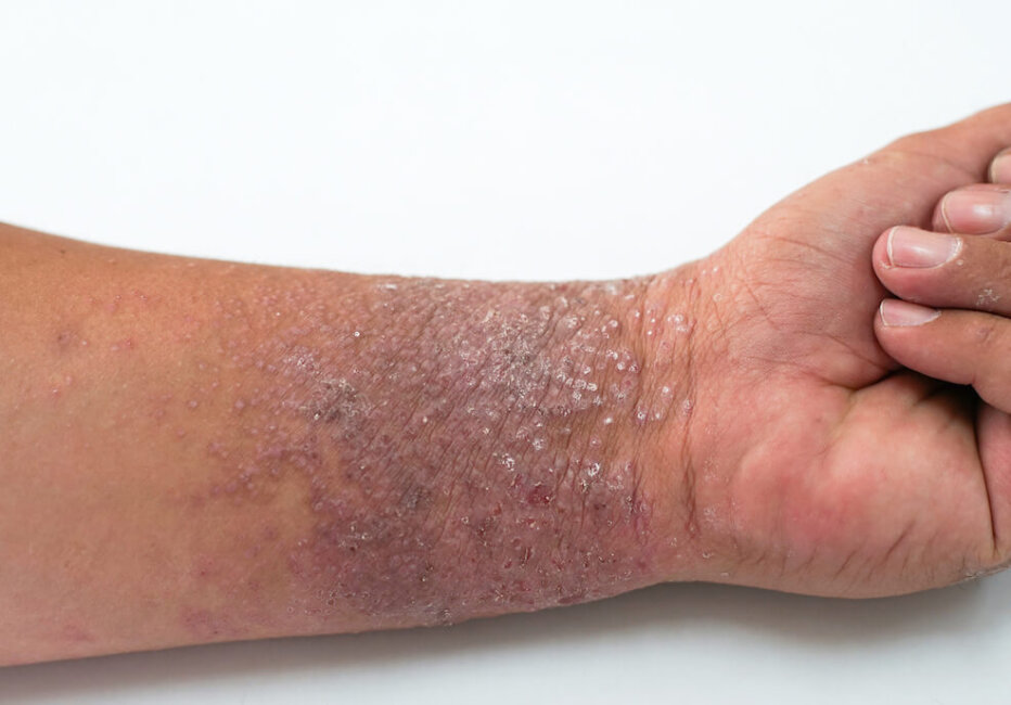 eczema treatment singapore