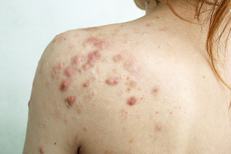 back acne keloid