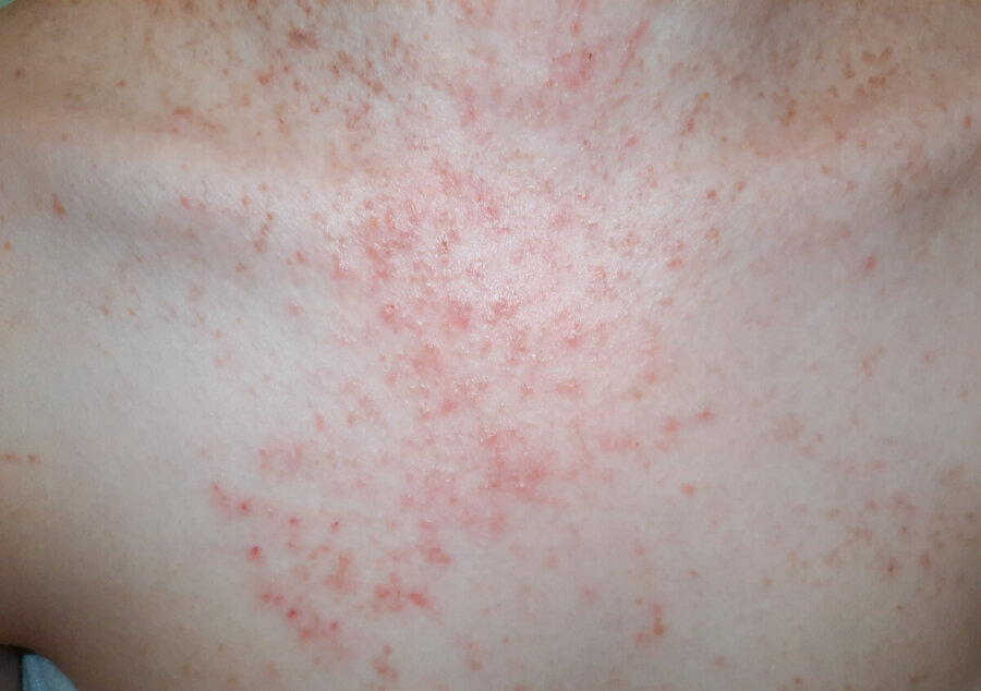 Fungal Skin Rash On Back Fungal Skin Rash On Back