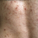 trifarotene back acne treatment