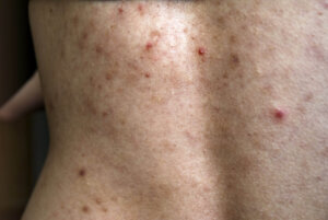 trifarotene back acne treatment