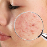 acne risk factors