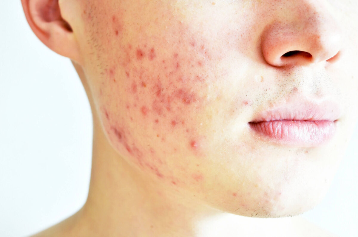 acne vulgaris on face