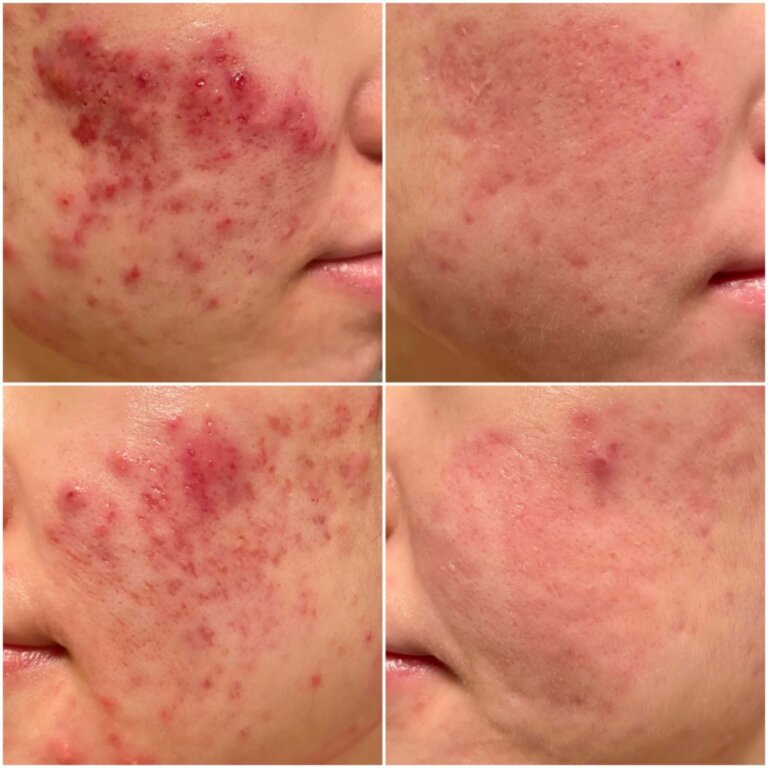 best cystic acne treatment