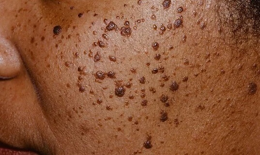 dermatosis papulosa nigra removal treatment