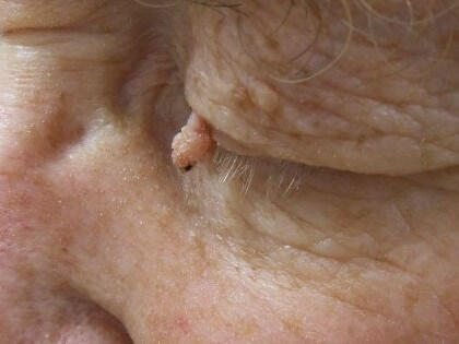 eyelid skin tag removal
