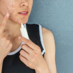 Hormonal Influences On Cystic Acne: Unravelling The Connection