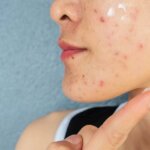 How To Identify And Prevent Early Signs Of Acne Scarring