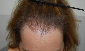male pattern hair loss in females