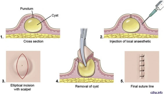 sebaceous cyst removal surgery