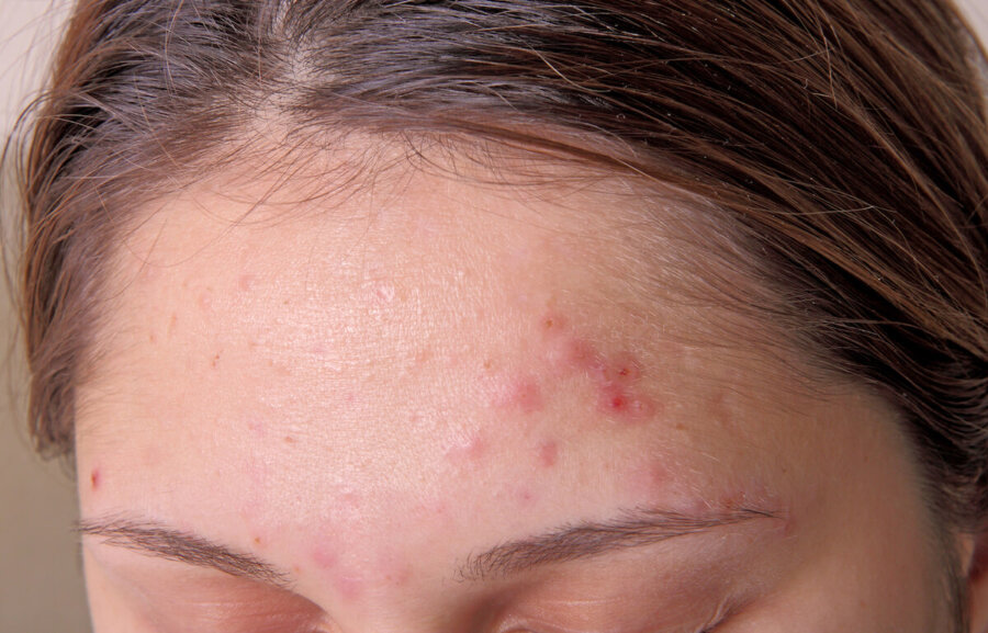 best teenage acne treatment singapore