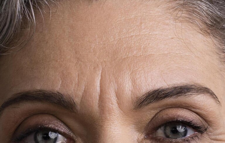glabella wrinkles