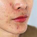 Hormonal Acne vs. Regular Acne: What’s The Difference?