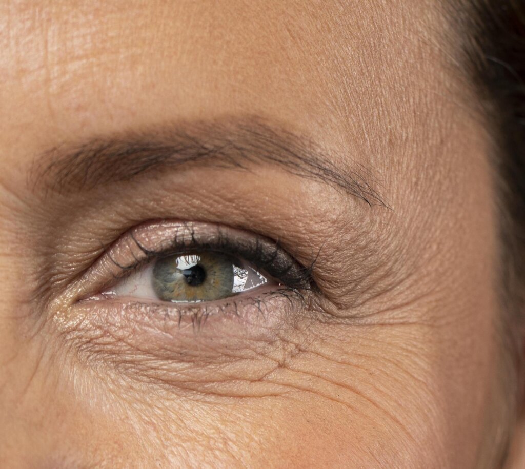 lower eyelid wrinkles