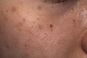 What Causes Skin Pigmentation & Can They Be Removed?