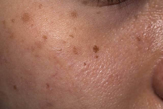 What Causes Skin Pigmentation & Can They Be Removed?