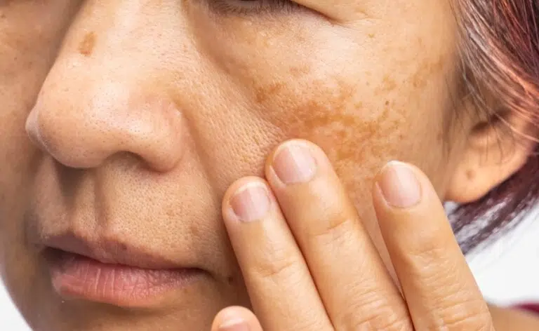 Melasma Singapore