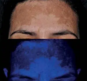 Epidermal Vs. Dermal Melasma Singapore
