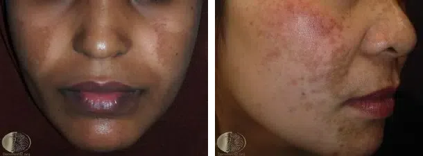 Melasma Appearance Singapore