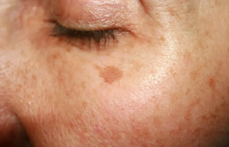 Freckles and Solar Lentigines Appearance Singapore