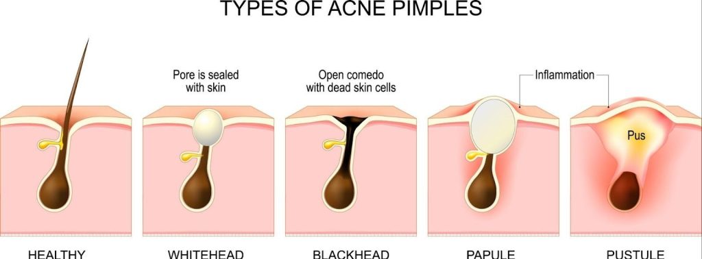 What Causes Acne Singapore