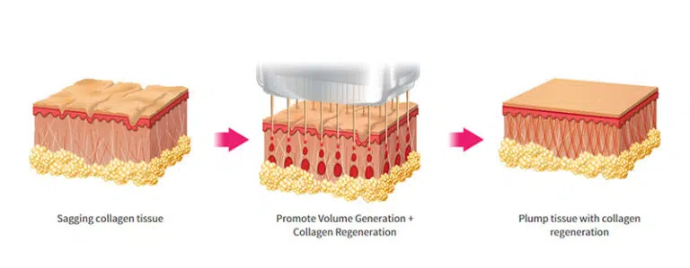 How Does Genius RF Microneedling Work Singapore
