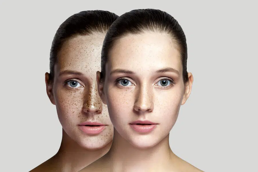 Freckles Singapore