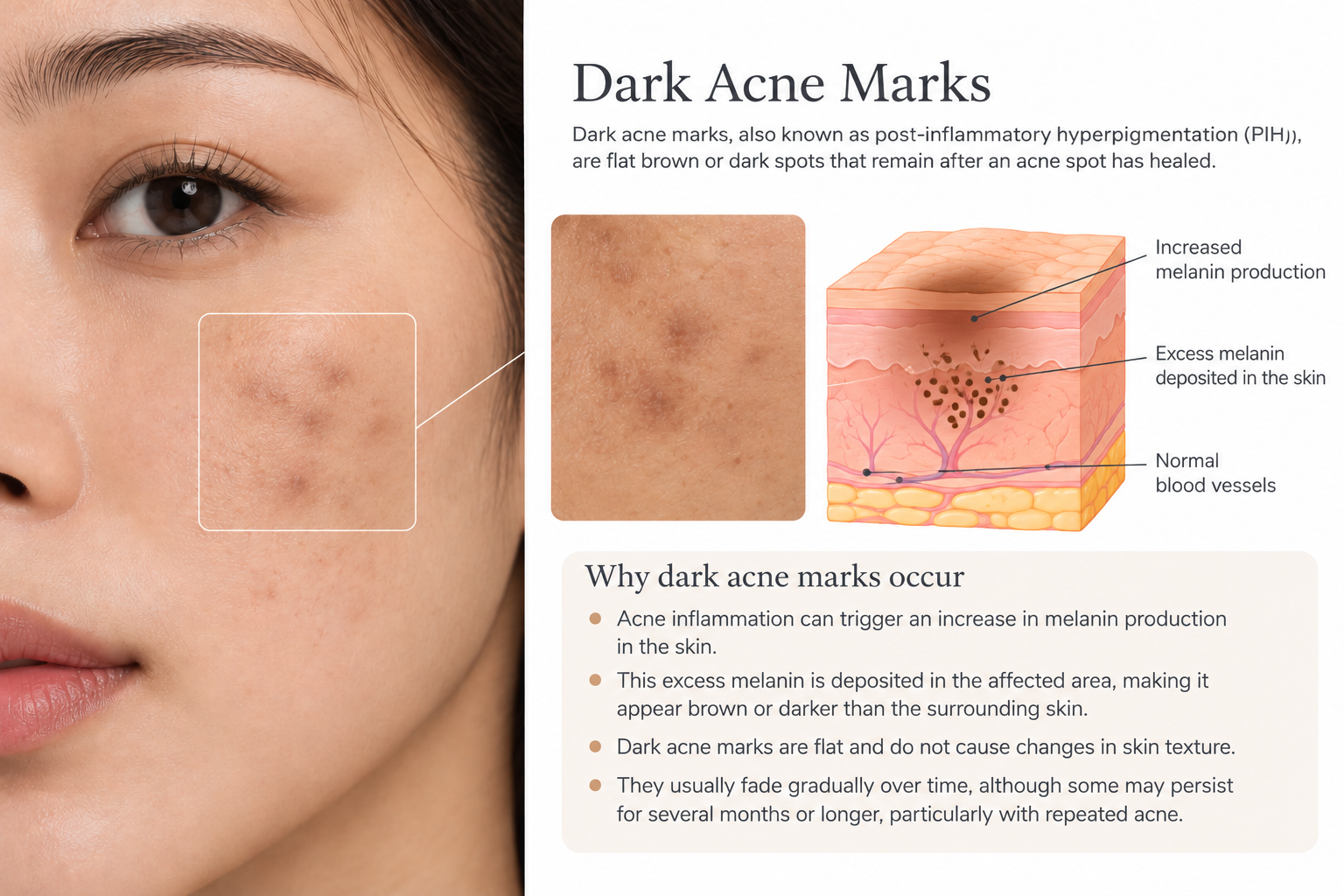Medical diagram showing dark acne marks with a cross-section of the skin illustrating excess melanin deposits associated with post-inflammatory hyperpigmentation (PIH).