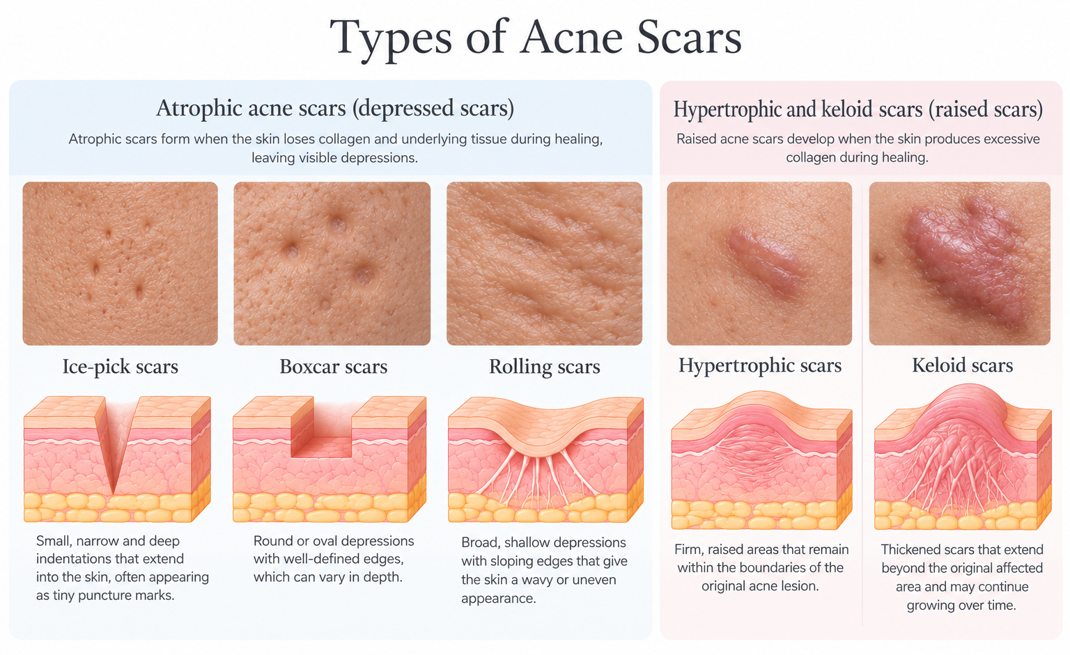 Medical diagram comparing five types of acne scars.